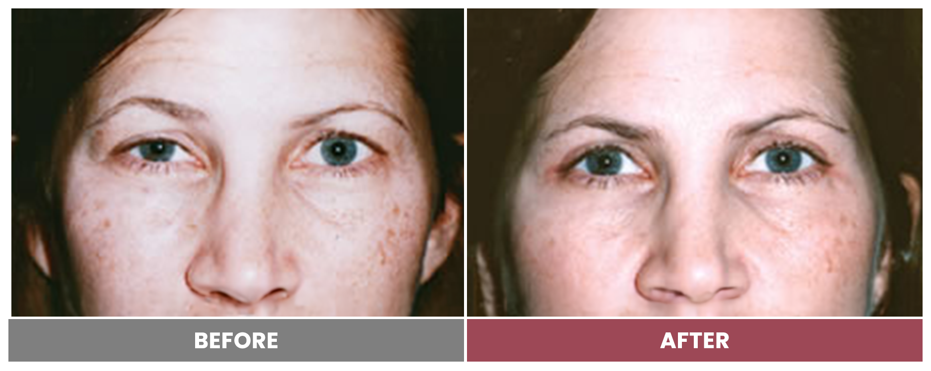 Upper Blepharoplasty - Case 64